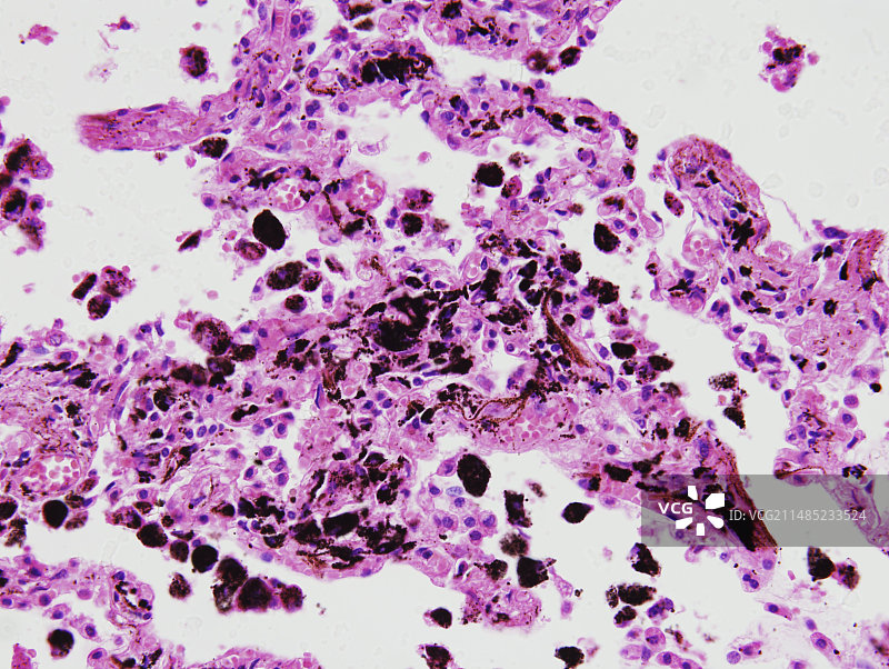 尘肺，光学显微照片图片素材