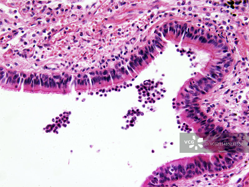 肺气肿，光学显微照片图片素材