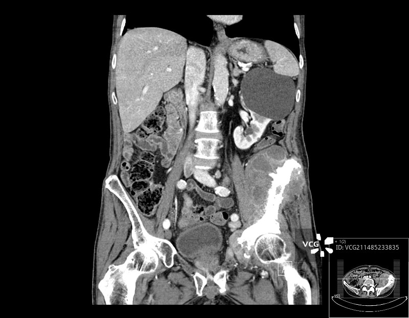 骨癌，CT扫描图片素材