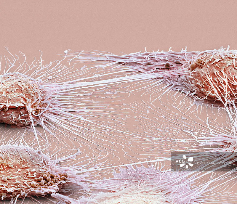 口腔癌细胞，扫描电子显微镜图片素材