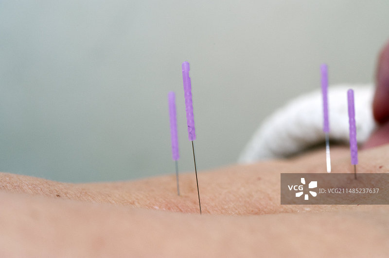 针灸图片素材