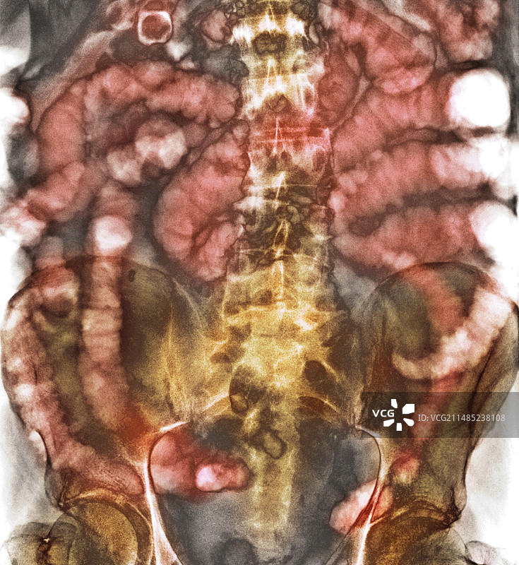 小肠梗阻X光片图片素材