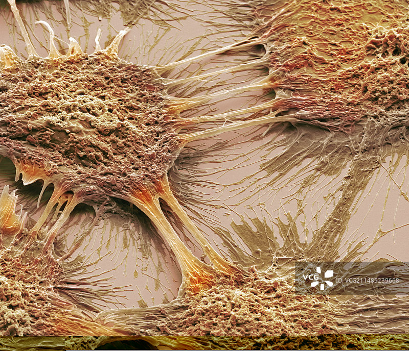 阴道癌细胞扫描电镜图图片素材