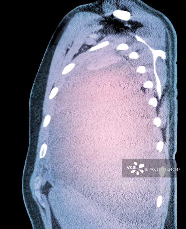 间皮瘤胸腔积液CT扫描图片素材
