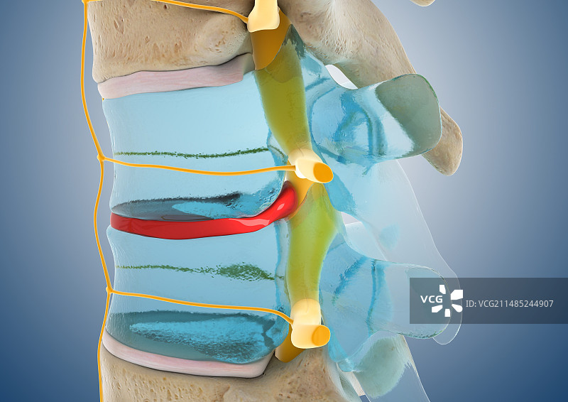 椎间盘脱出艺术图图片素材