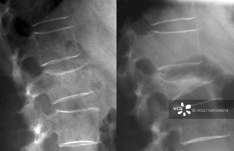 骨质疏松症脊柱骨折X光片图片素材