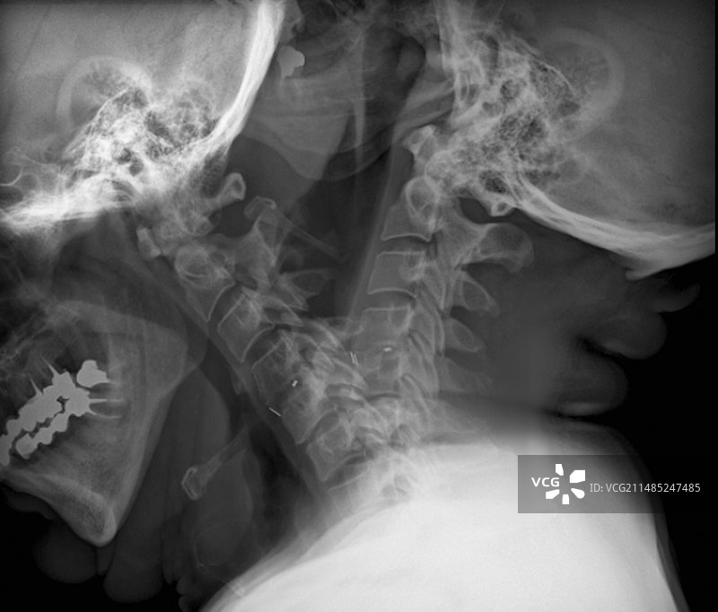 脊柱固定X光片图片素材