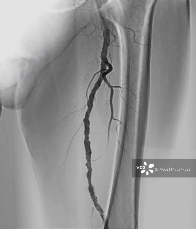 动脉粥样硬化，X光片图片素材