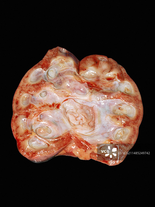 肿胀的肾脏图片素材