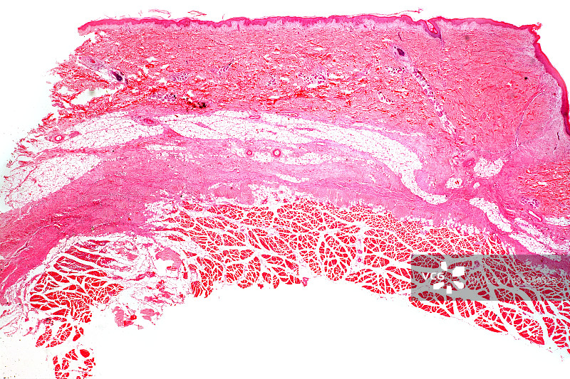 手术疤痕显微照片图片素材