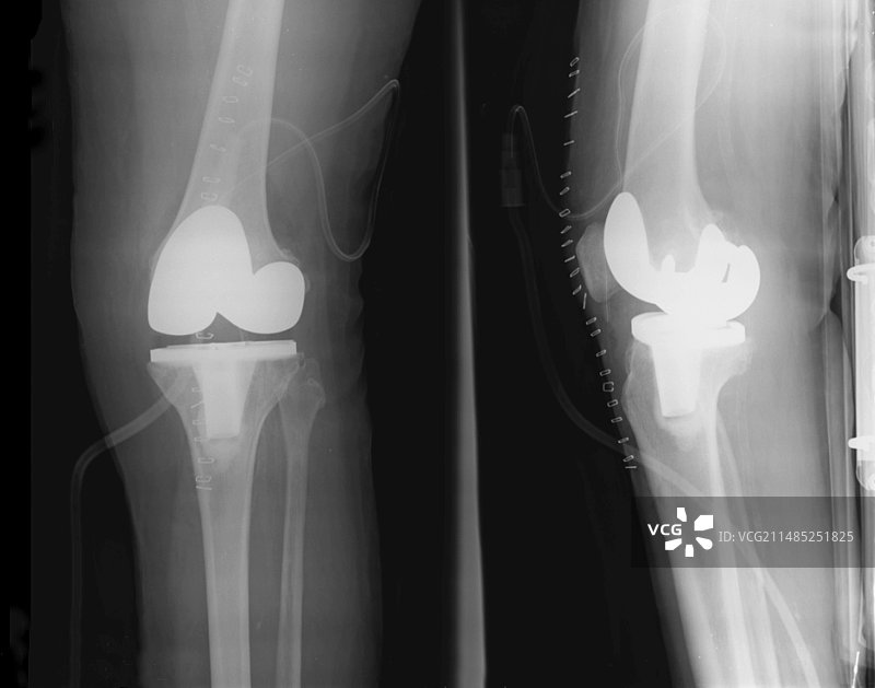 膝关节置换，X光片图片素材