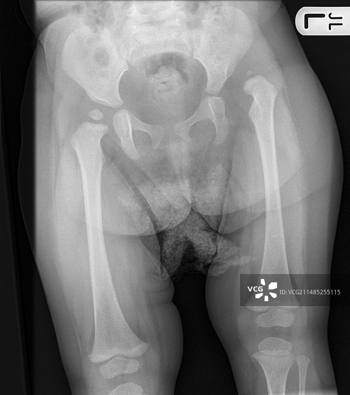 先天性髋关节脱位X光片图片素材