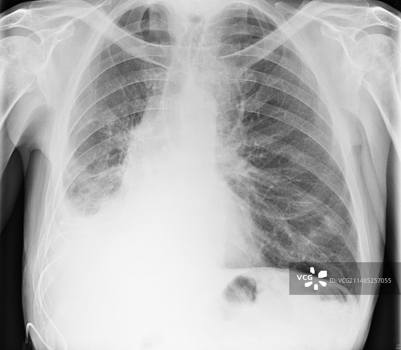 伴有胸腔积液的肺癌X光片图片素材