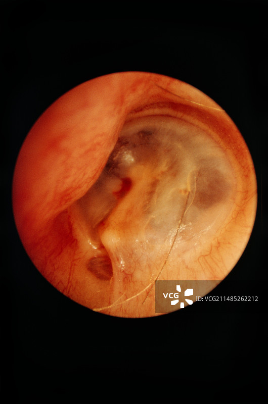 耳膜的耳镜观察图图片素材