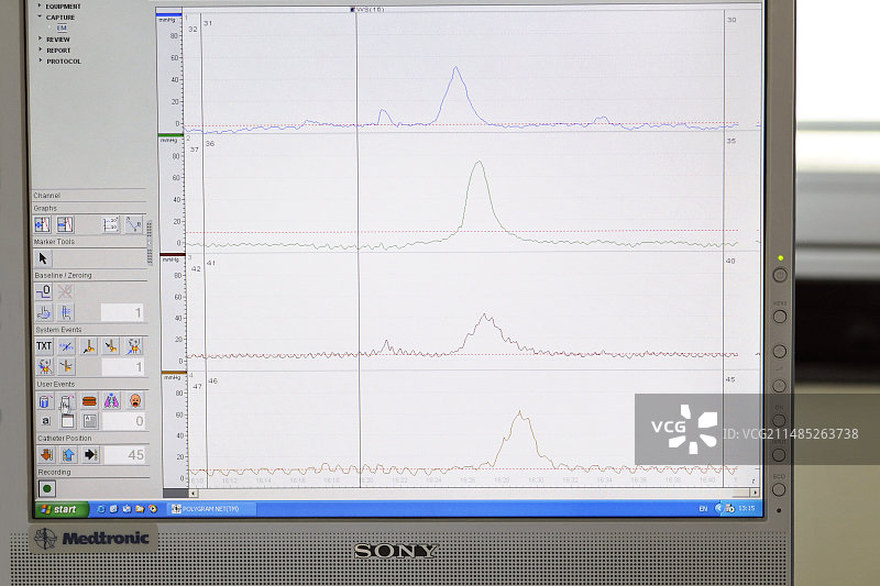 食管测压和pH值测试图片素材
