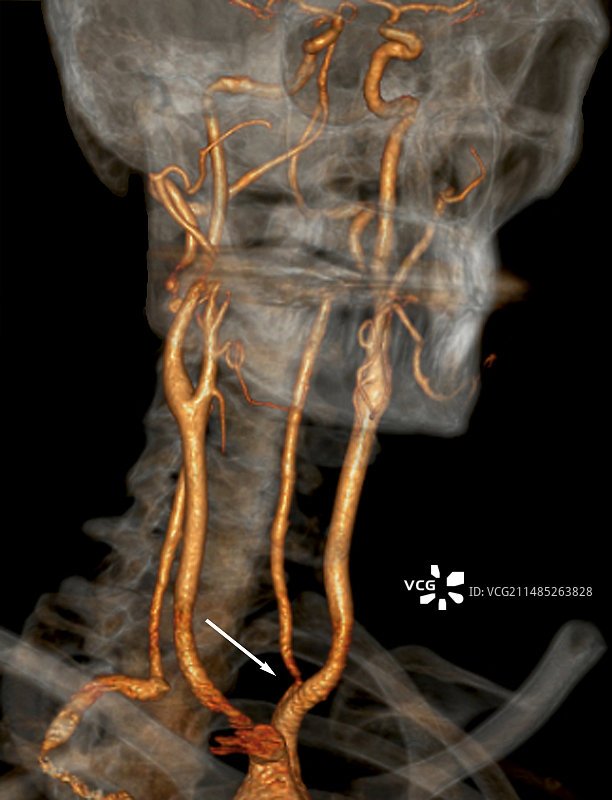 颈动脉狭窄CT扫描图片素材