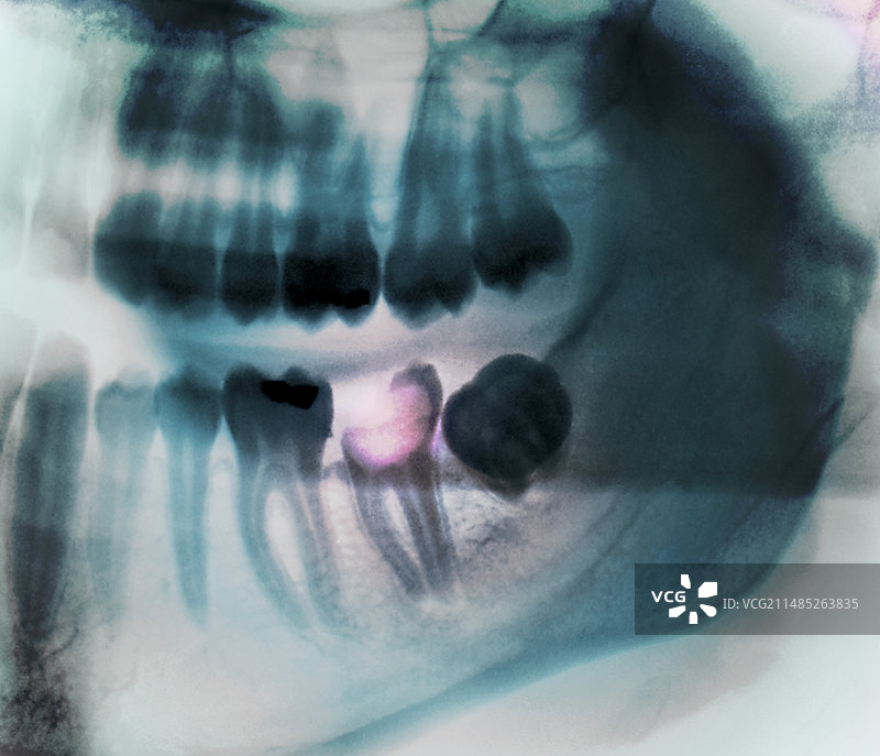 龋齿X光片图片素材