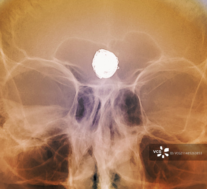 治疗后的颅内浆果动脉瘤X光片图片素材