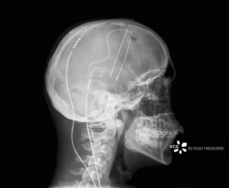 抽动秽语综合征治疗X光片图片素材