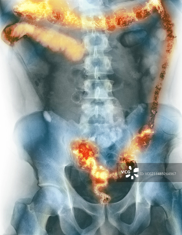 溃疡性结肠炎X光片图片素材