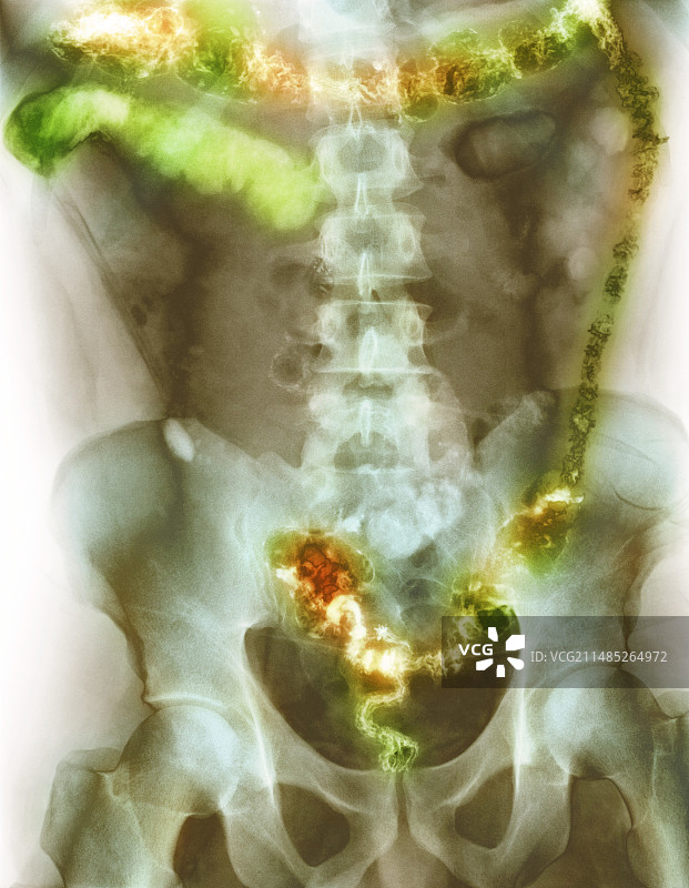 溃疡性结肠炎X光片图片素材