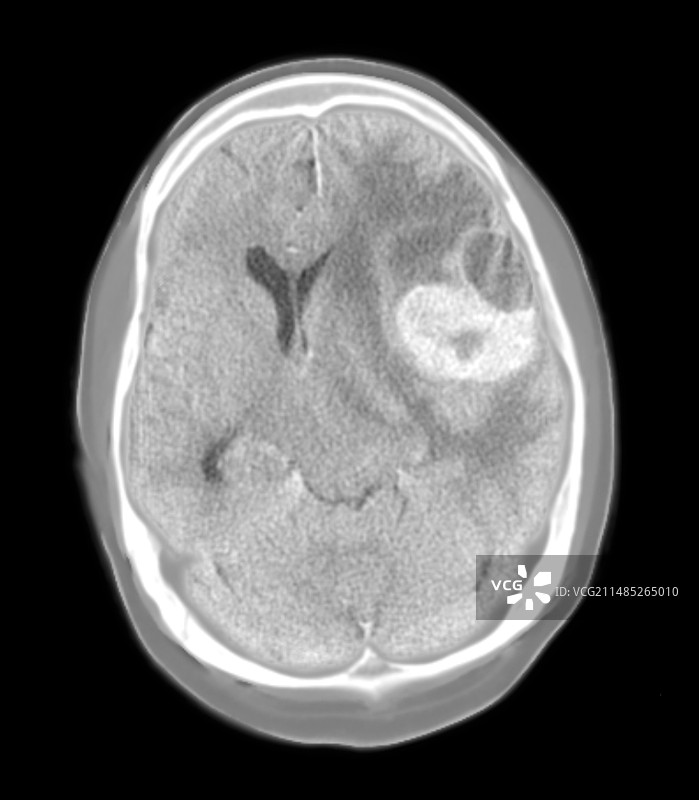 脑癌CT扫描图片素材
