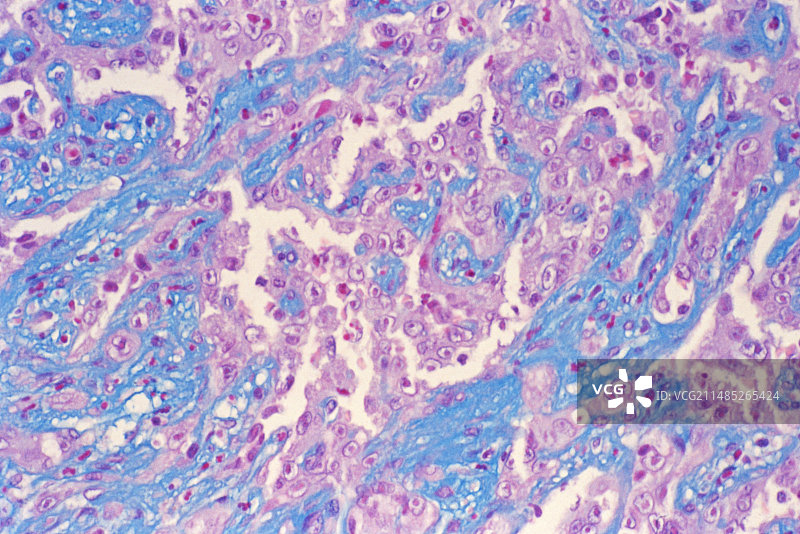 血管肉瘤，光学显微照片图片素材