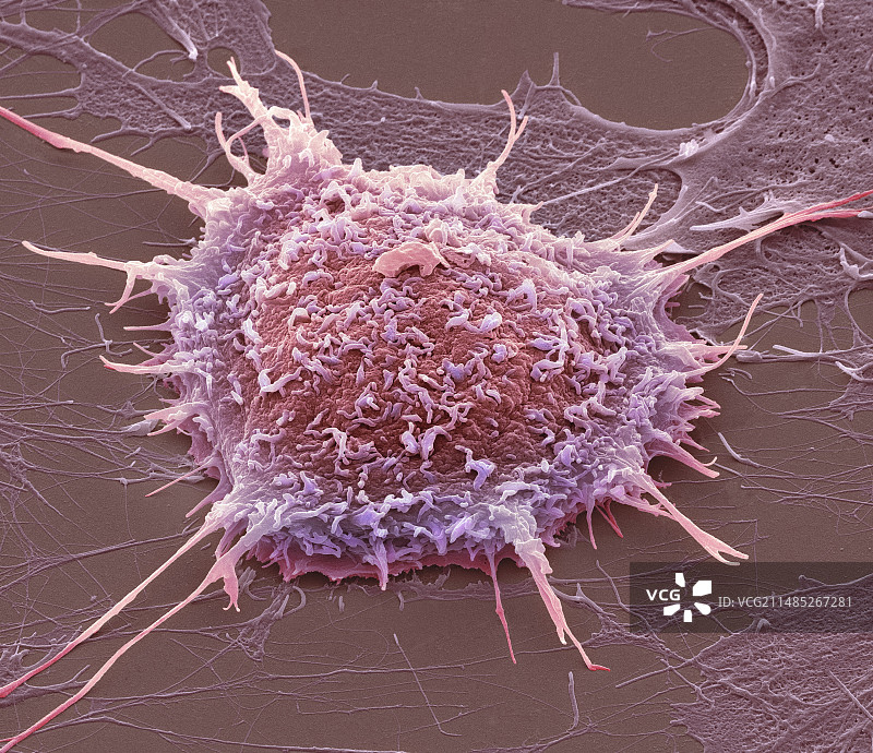 宫颈癌细胞扫描电镜图图片素材