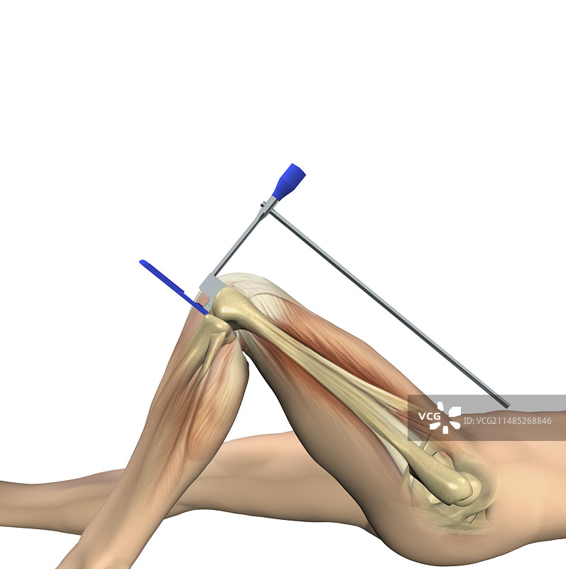 膝关节置换术局部图图片素材