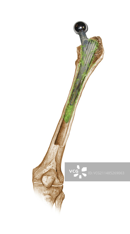 髋关节置换失败合成图像图片素材