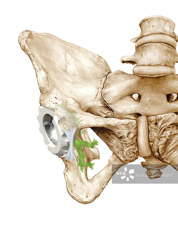髋关节置换术图片素材
