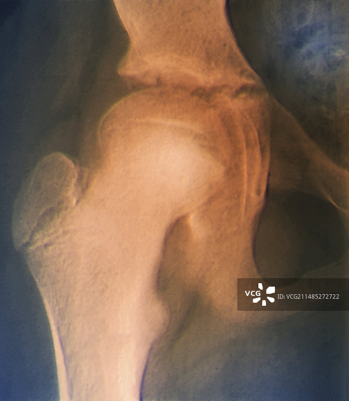 股骨末端滑脱X光片图片素材