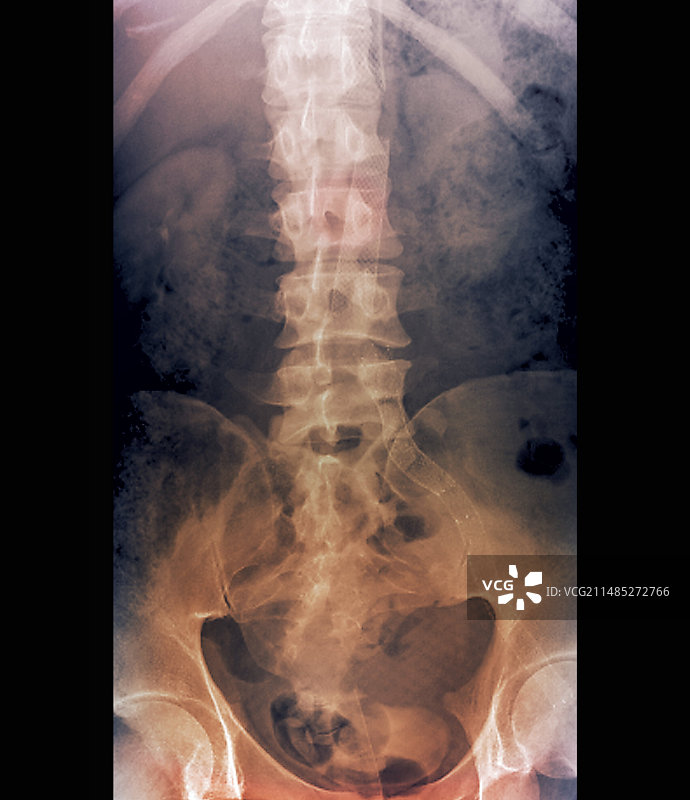治疗主动脉动脉瘤的支架X光片图片素材