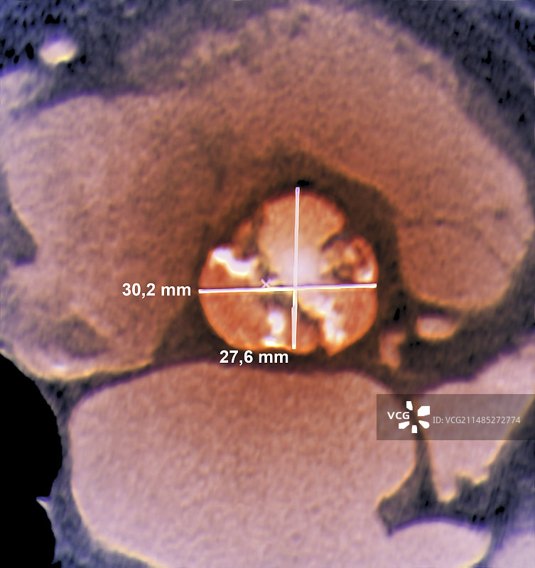钙化性心脏瓣膜CT扫描图片素材
