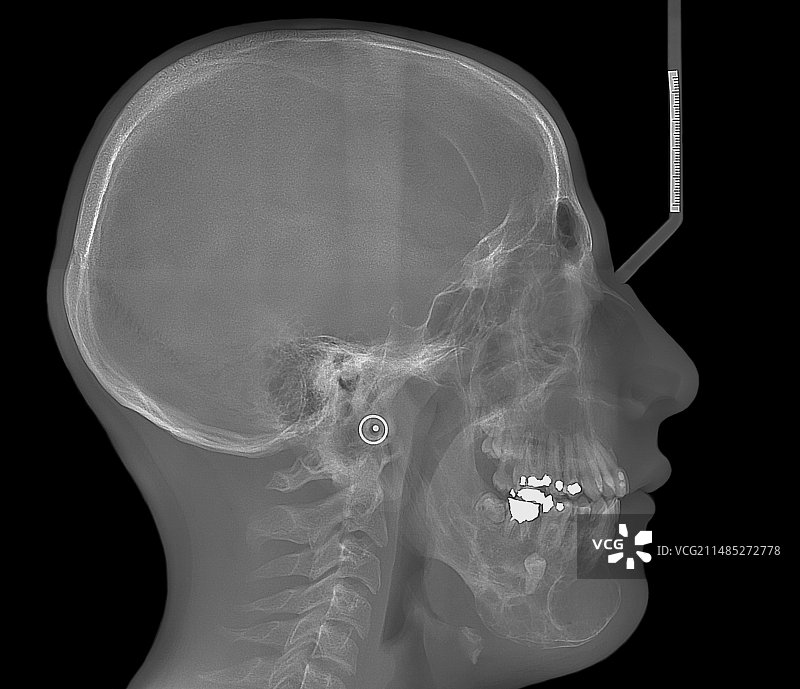 颌骨癌（成釉细胞瘤）X光片图片素材