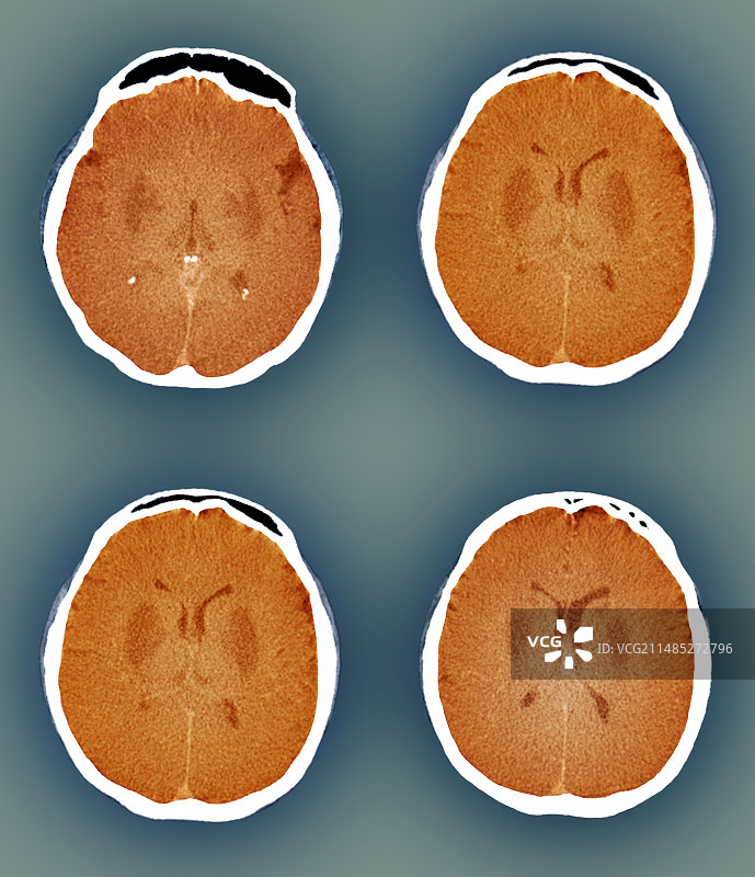 昏迷中的大脑，CT扫描图片素材