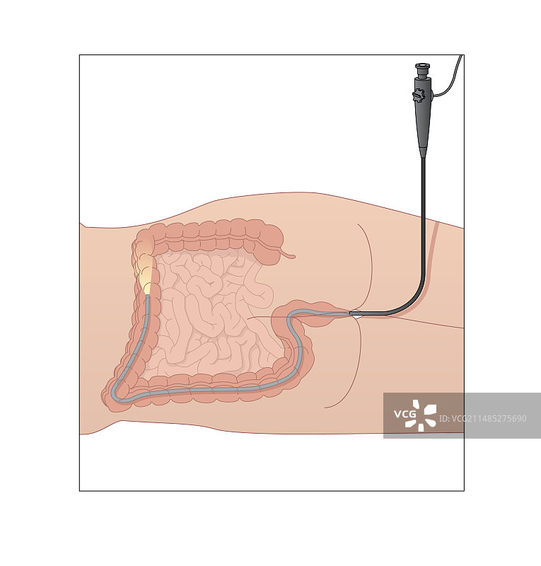 结肠镜检查艺术图图片素材