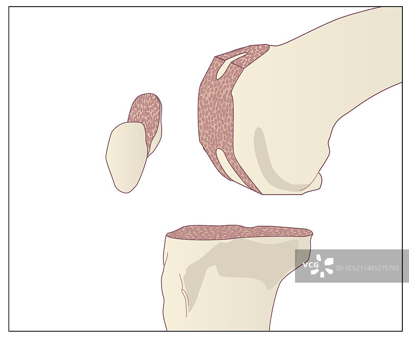 膝关节置换术图片素材