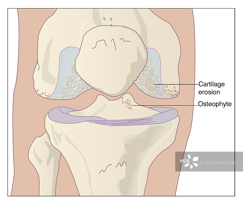 骨关节炎膝盖图片素材