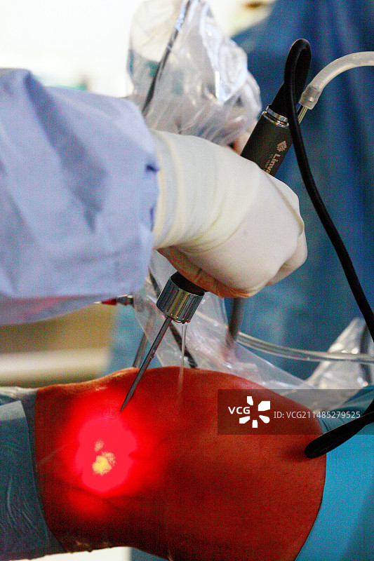 膝关节镜检查图片素材