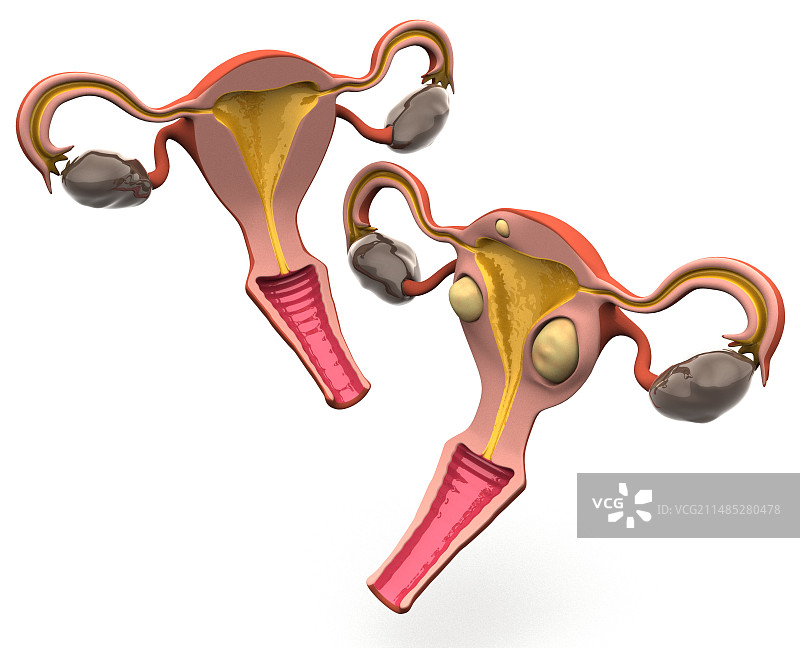 子宫肌瘤图片素材