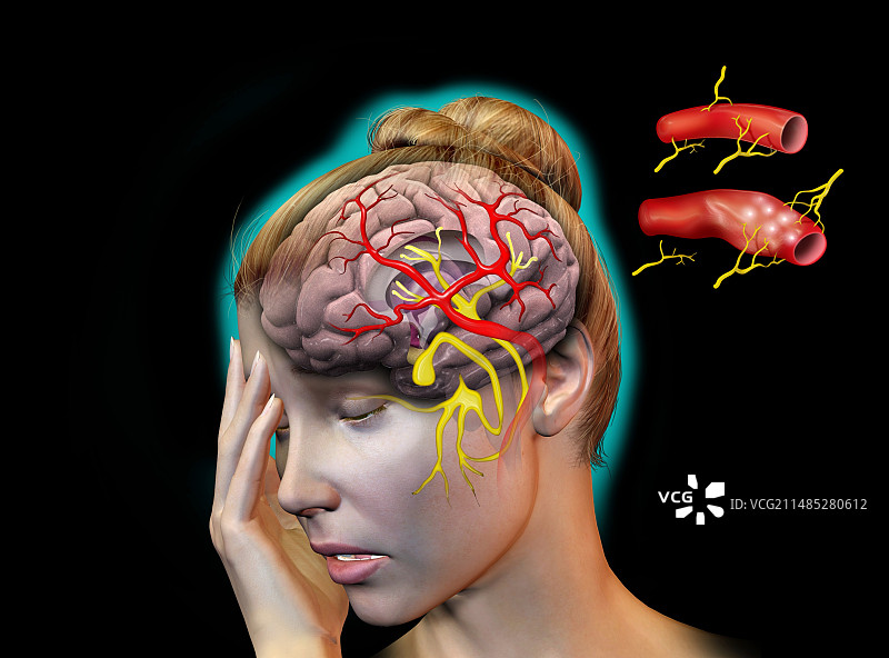 头痛的血管原因图片素材