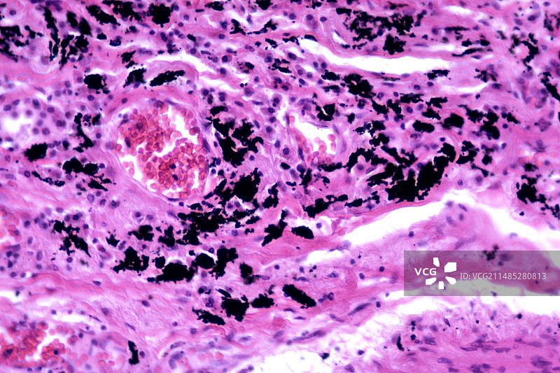 肺炭末沉着病图片素材
