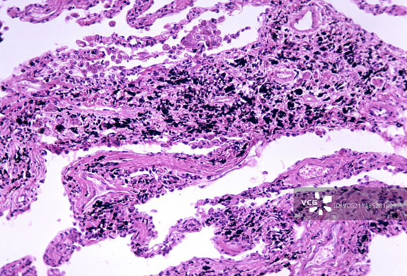 矽肺病肺部切片显微照片图片素材