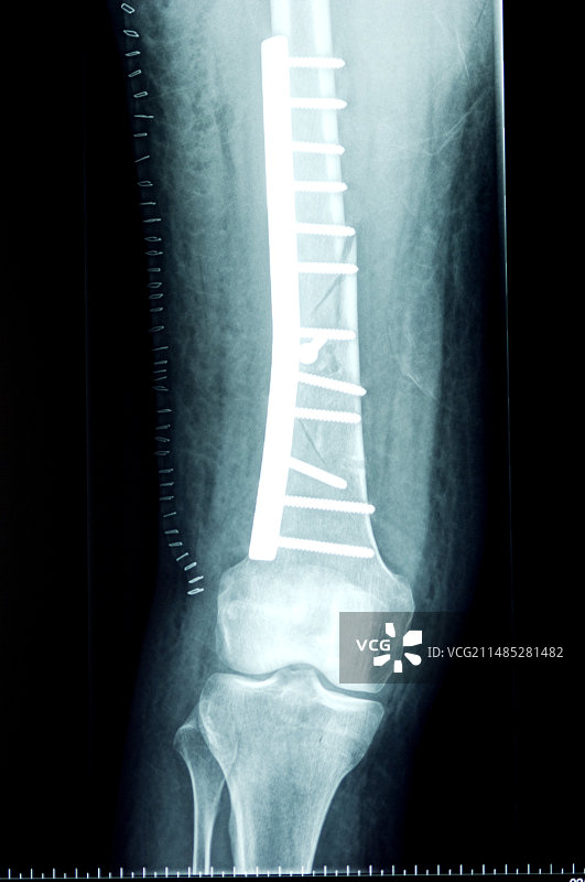 腿部股骨骨折X光片图片素材