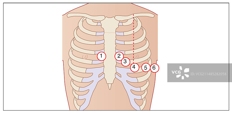 心电图电极放置示意图图片素材