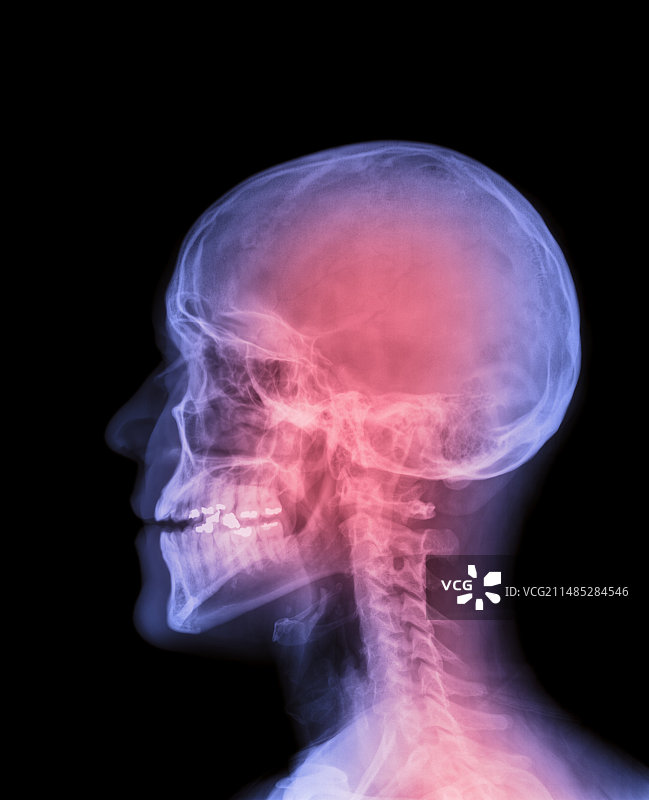 人头X光片图片素材
