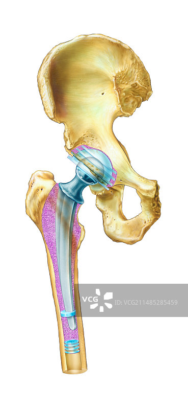 髋关节置换术图片素材