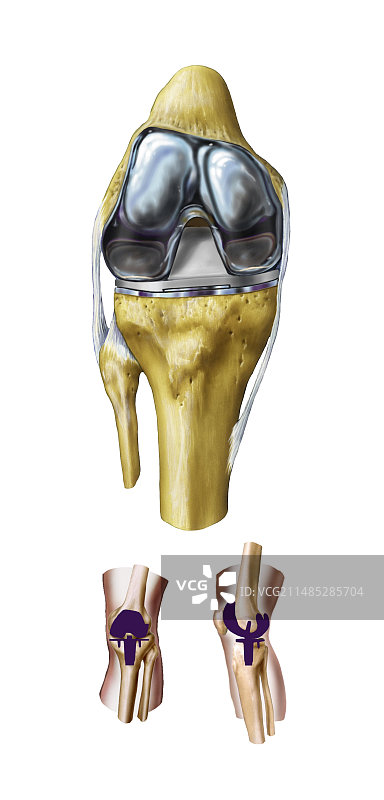 膝关节置换术图片素材