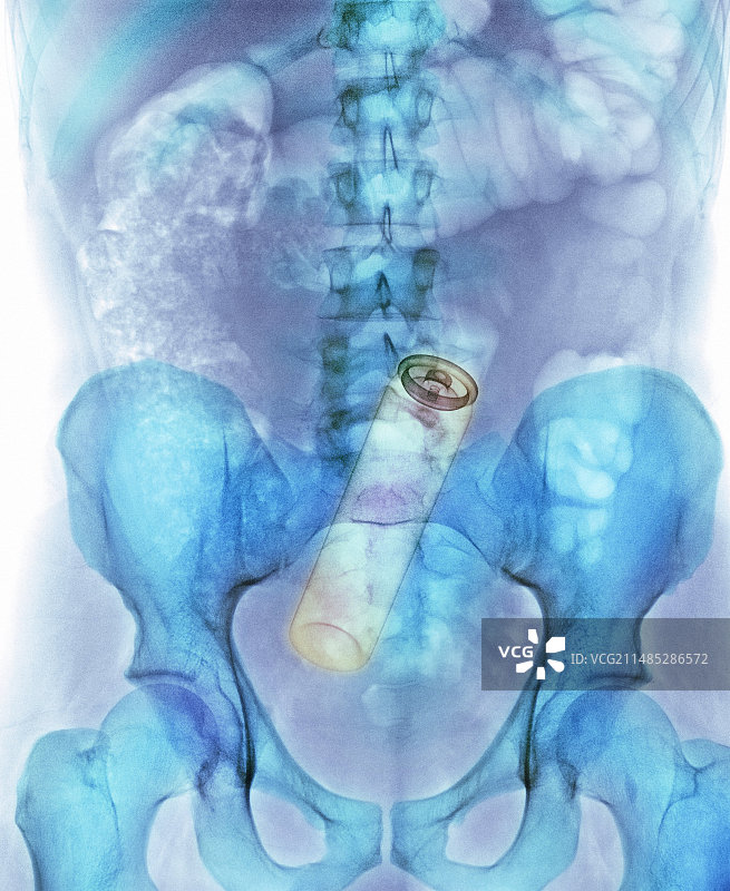 男子直肠内的除臭剂罐X光片图片素材
